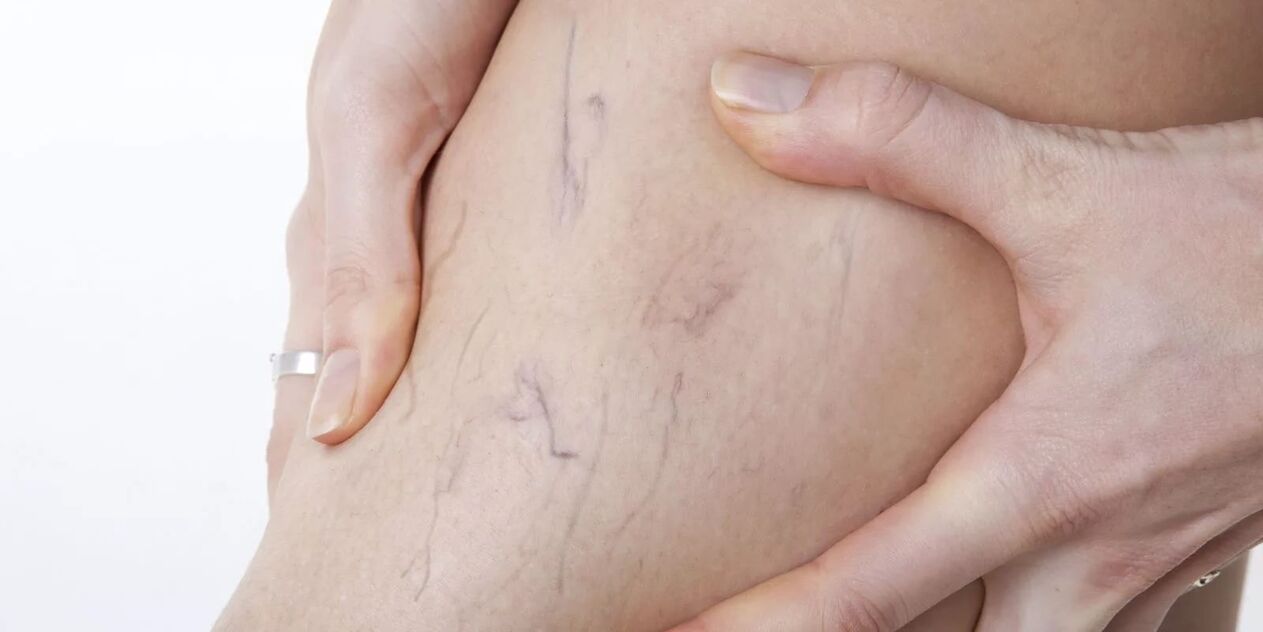 Πριν χρησιμοποιήσετε κρέμα Varicon